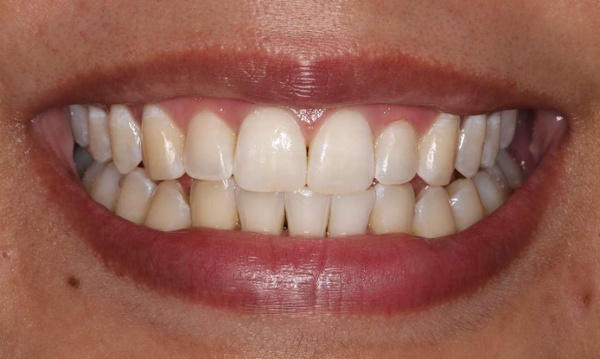 close up of smile after braces