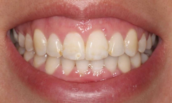 straight front teeth after braces