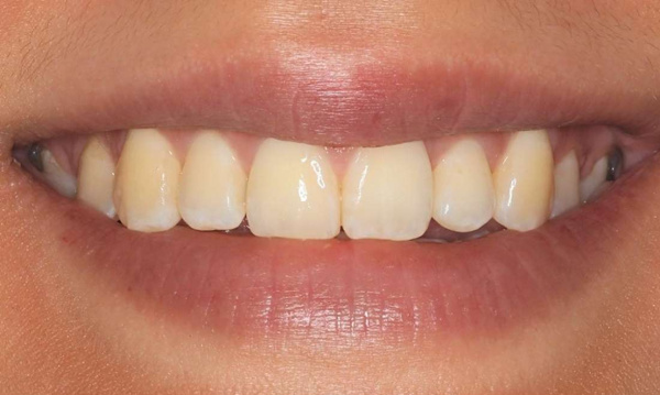 straighter smile after braces