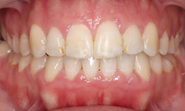  straight front teeth after braces