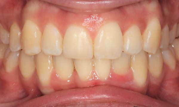straight front teeth after braces