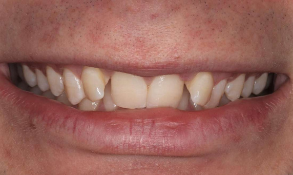 close up of smile before braces