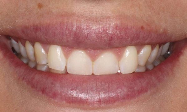 smile before orthodontics