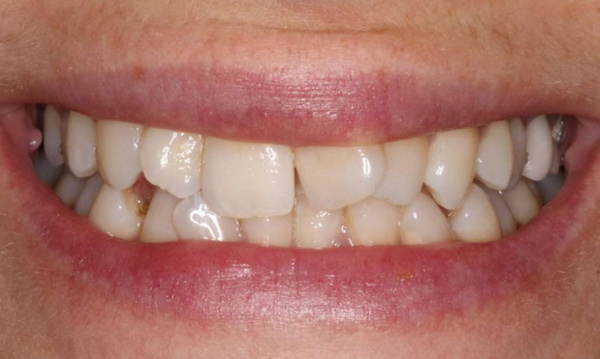 crooked front tooth before ortho