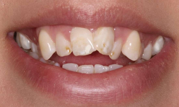 crowded and crooked front teeth