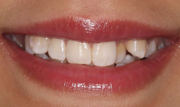 before braces
