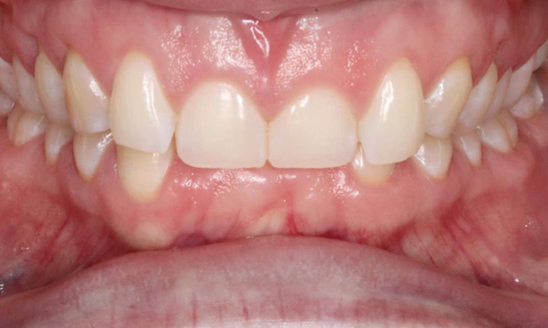 smile before orthodontics in bondi