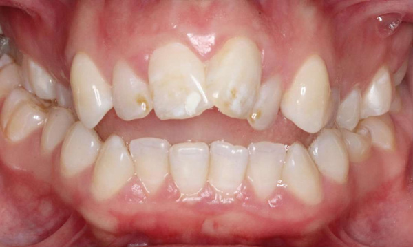 crowded and crooked front teeth 