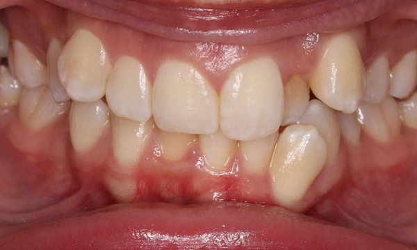 crooked front teeth