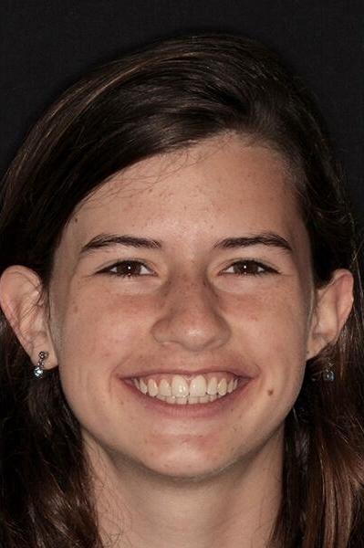 Teen-Braces-After-Image