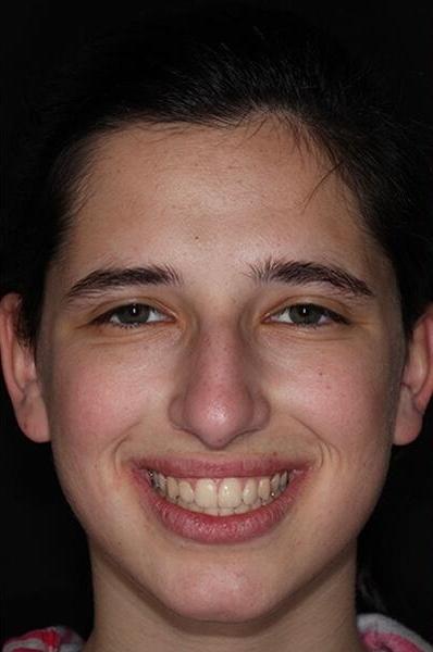 Teen-Orthodontics-After-Image