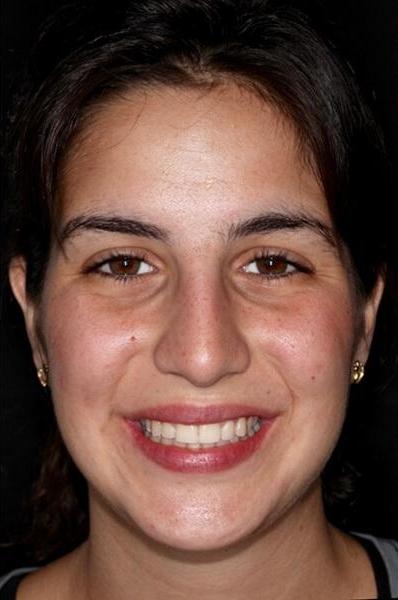 teen Ortho patient after braces 