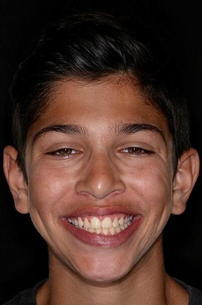 teen Ortho patient after braces and expander plate