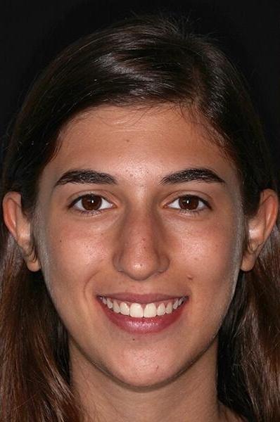 adolescent Ortho patient after braces