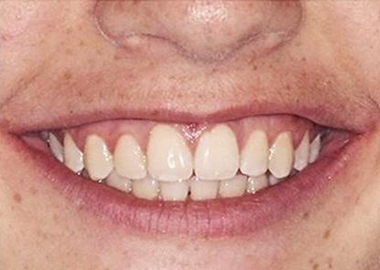 Ortho patient after braces