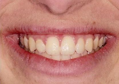 Ortho patient mouth close up after procedure