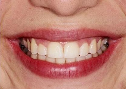 close up of teen ortho patient after braces treatment