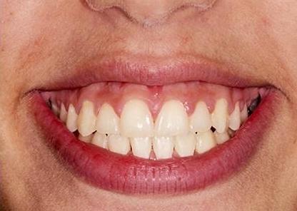 Ortho patient after pictures close up