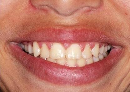 close up of teen Ortho patient after braces and expander plate