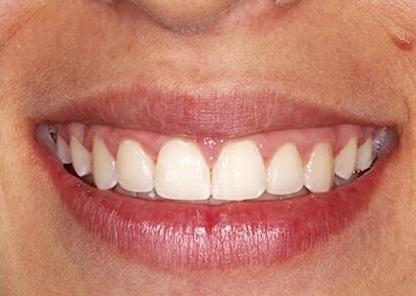 adolescent Ortho patient after braces close up