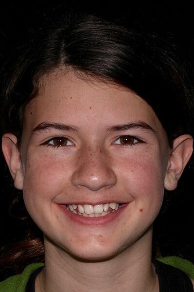 Teen-Braces-Before-Image