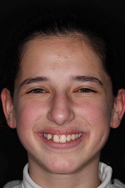 Teen-Orthodontics-Before-Image