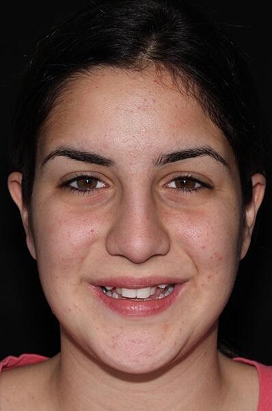 teen Ortho patient before braces treatment