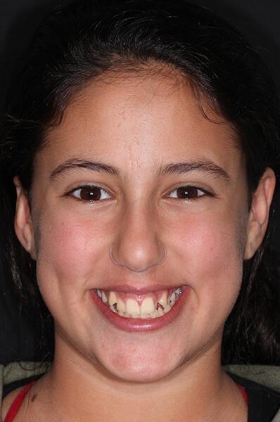 Ortho patient before pictures