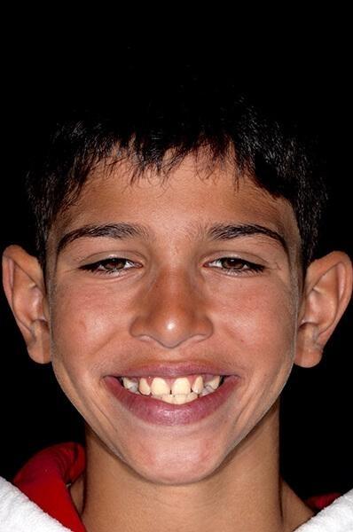 teen Ortho patient before braces and expander plate