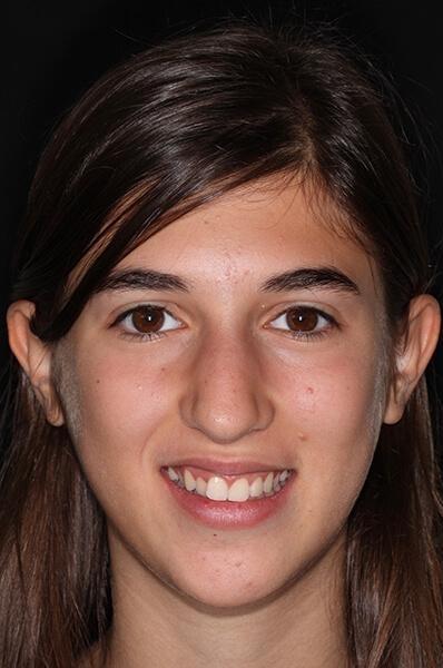 adolescent Ortho patient before braces