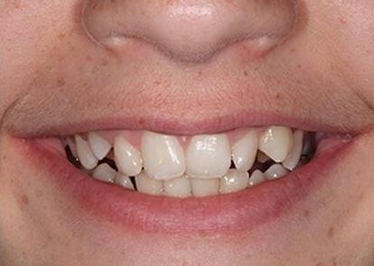Ortho patient before braces