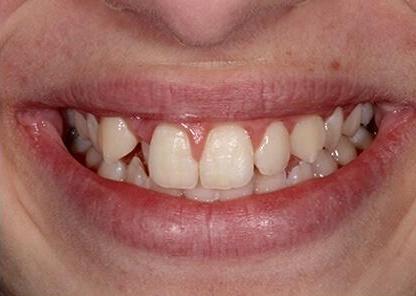 Ortho patient mouth close up before procedure