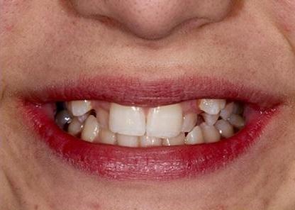 close up of teen ortho patient before braces treatment