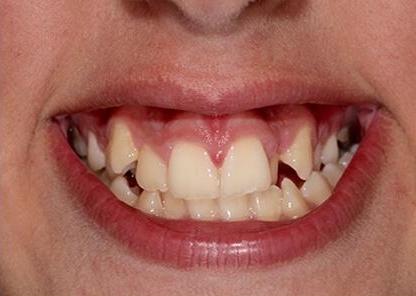 Ortho patient before pictures close up