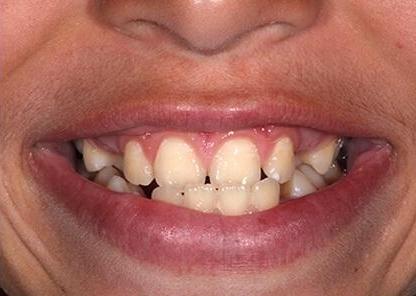 close up of teen Ortho patient before braces and expander plate
