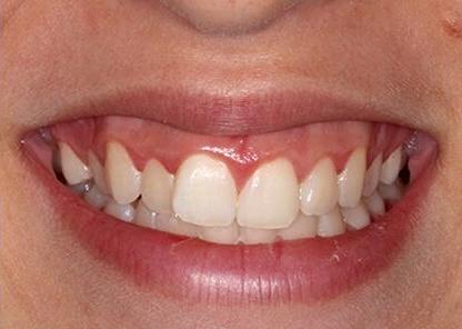 adolescent Ortho patient before braces close up