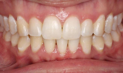 close up of smile after braces