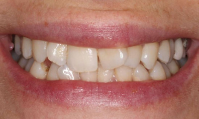 crooked front tooth before ortho