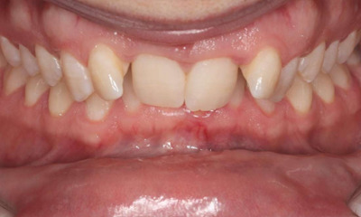 close up of smile before braces