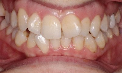 crooked front teeth before ortho