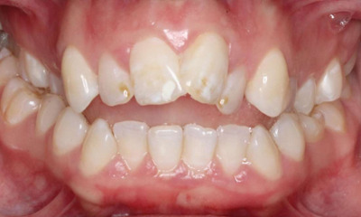crowded and crooked front teeth 