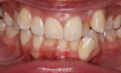 crooked front teeth